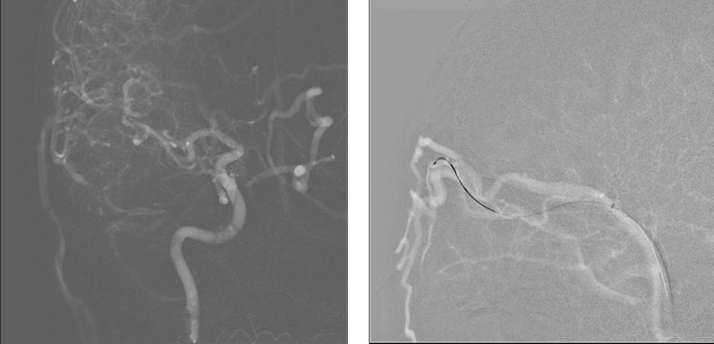 Right middle temporal vein