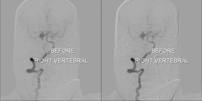 Right PCA Aneurysm