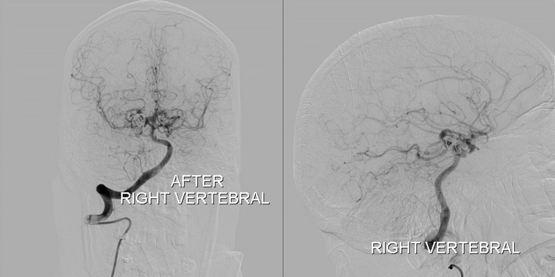 Right PCA Aneurysm