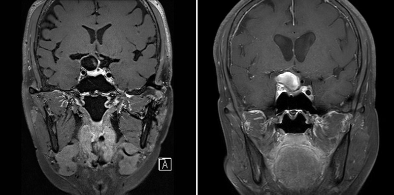 Right visual disturbance due to increased mass effect