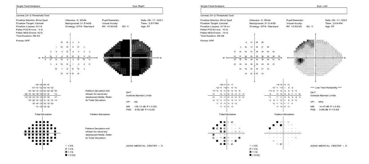 Right visual disturbance