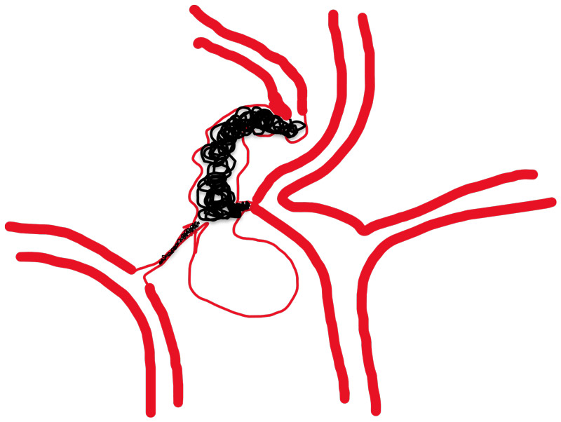 Rt A1 was coiled