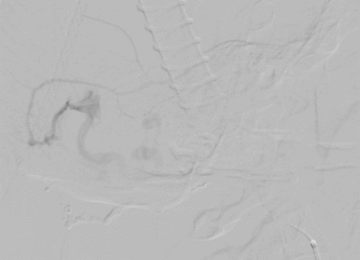 Selective catheterization and embolization of fistula