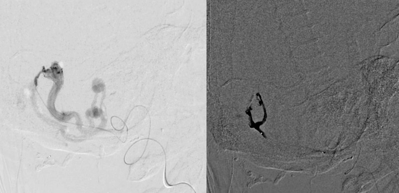 Selective catheterization of PICA artery and embolization of fistula from PICA