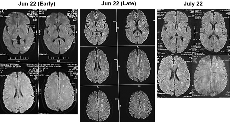 Sequential asymptomatic intracranial atherosclerosis (ICAD)