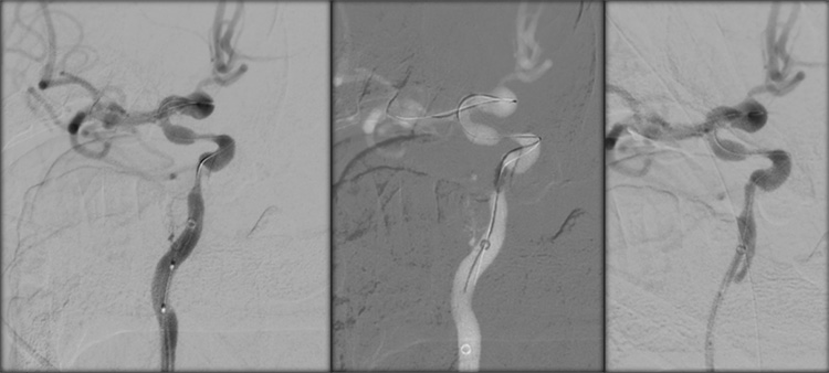Sequential asymptomatic intracranial atherosclerosis (ICAD)