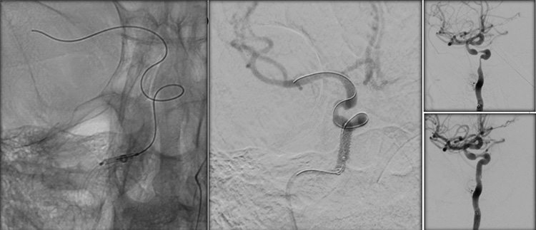 Sequential asymptomatic intracranial atherosclerosis (ICAD)