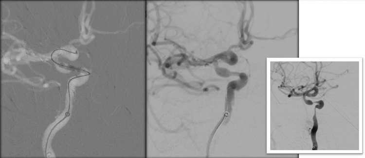 Sequential asymptomatic intracranial atherosclerosis (ICAD)