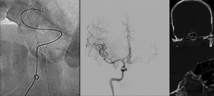 Sequential asymptomatic intracranial atherosclerosis (ICAD)