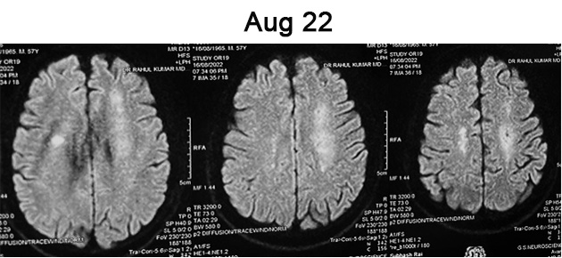 Sequential asymptomatic intracranial atherosclerosis (ICAD)