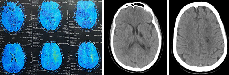Sequential asymptomatic intracranial atherosclerosis (ICAD)