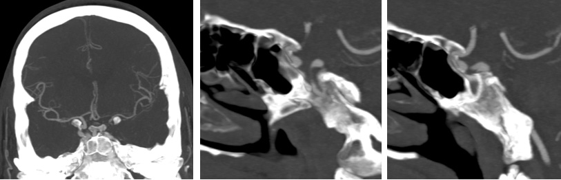 Sequential asymptomatic intracranial atherosclerosis (ICAD)