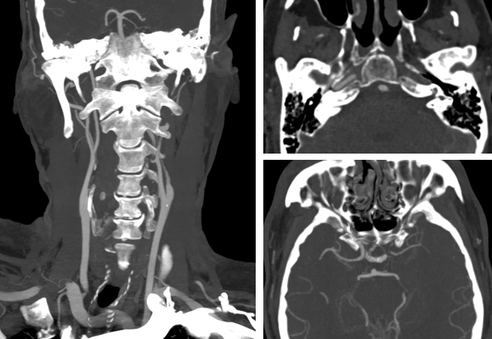 Sequential asymptomatic intracranial atherosclerosis (ICAD)