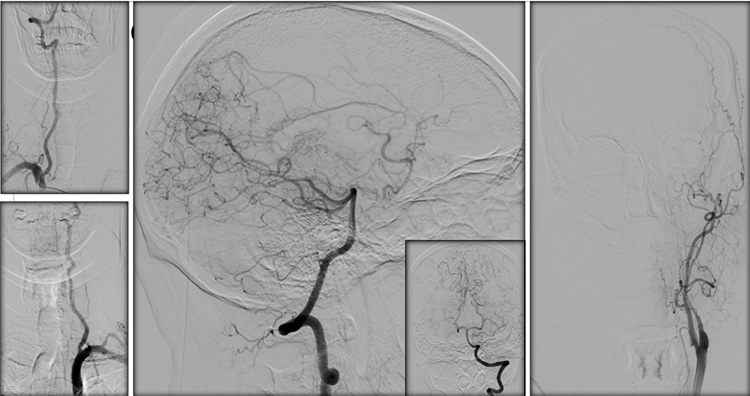 Sequential asymptomatic intracranial atherosclerosis (ICAD)