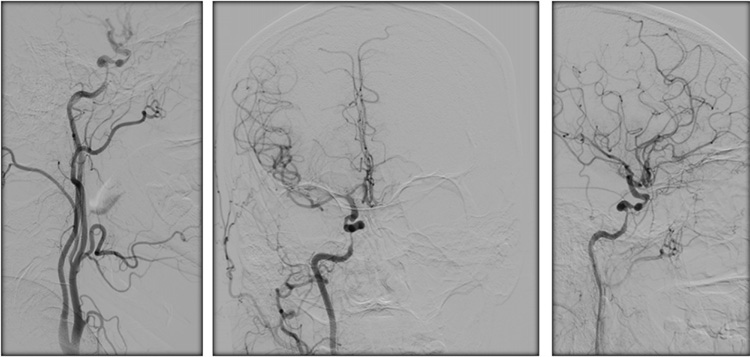 Sequential asymptomatic intracranial atherosclerosis (ICAD)