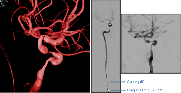 Sequential asymptomatic intracranial atherosclerosis (ICAD)