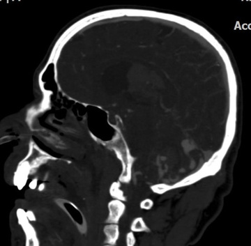 Sign of hemorrhage in posterior fossa and 3rd ventricle