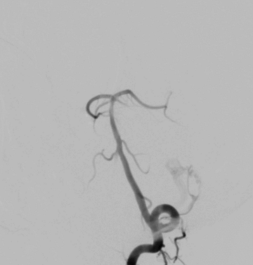 DSA: small fistula from meningeal branch of vertebral artery