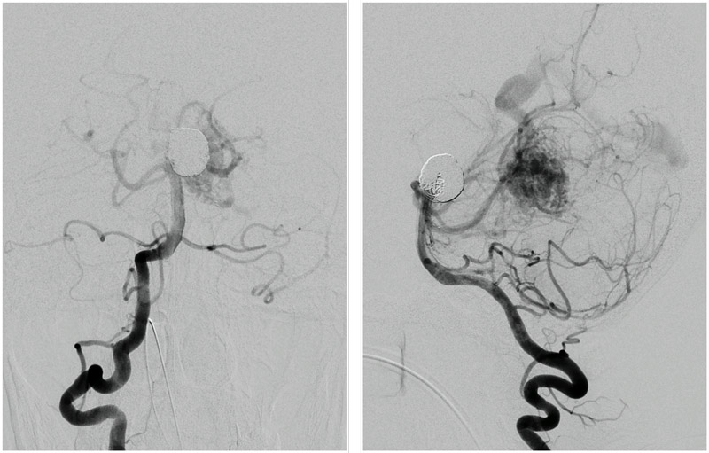 Stent-assisted coil embolization