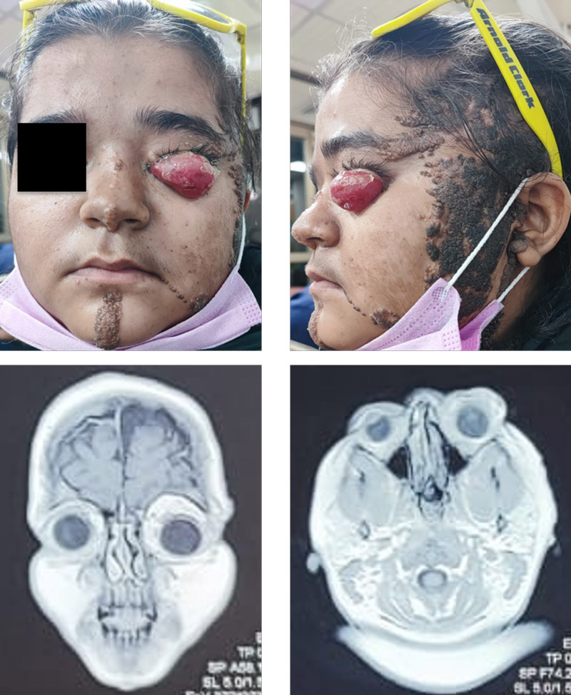 Swelling and proptosis of left eye x 12 months