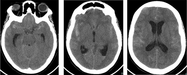 Tale of dual Malady in a Ruptured Aneurysm