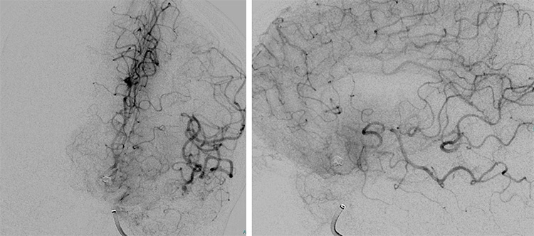 Tale of dual Malady in a Ruptured Aneurysm