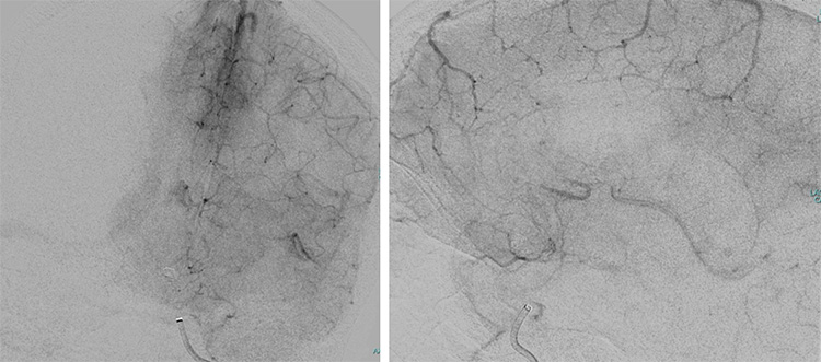 Tale of dual Malady in a Ruptured Aneurysm