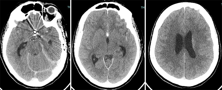 Tale of dual Malady in a Ruptured Aneurysm