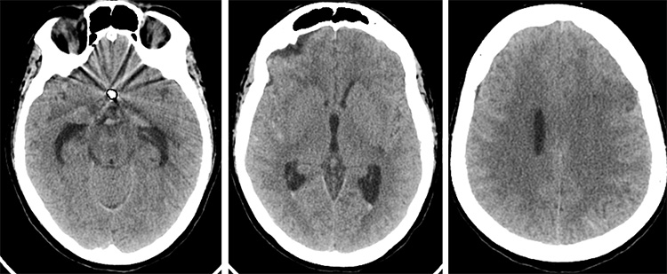 Tale of dual Malady in a Ruptured Aneurysm