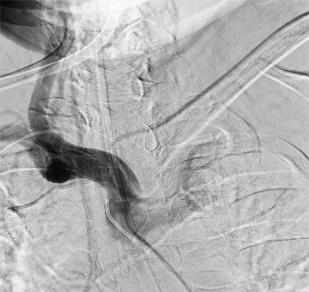 Tale of dual Malady in a Ruptured Aneurysm