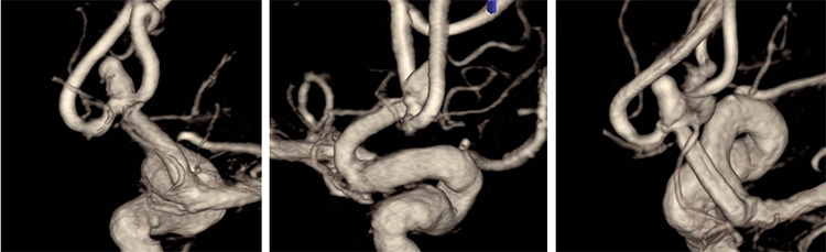Tale of dual Malady in a Ruptured Aneurysm