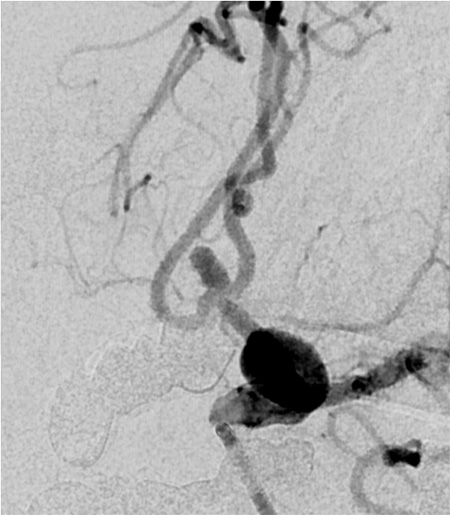 Tale of dual Malady in a Ruptured Aneurysm