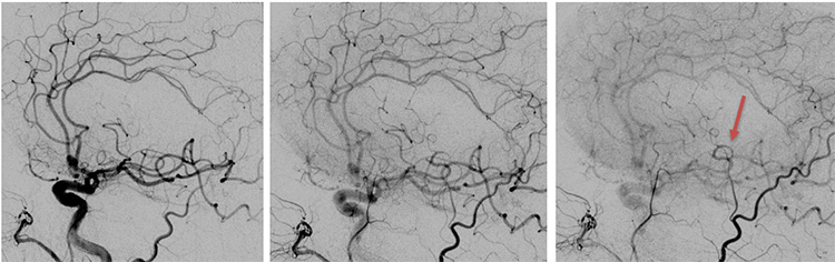 Tale of dual Malady in a Ruptured Aneurysm