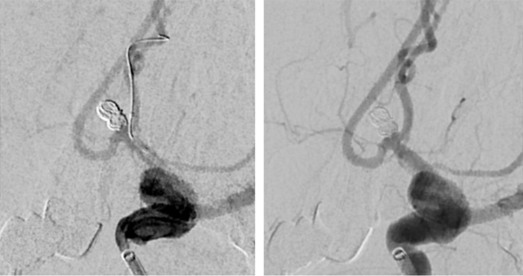 Tale of dual Malady in a Ruptured Aneurysm