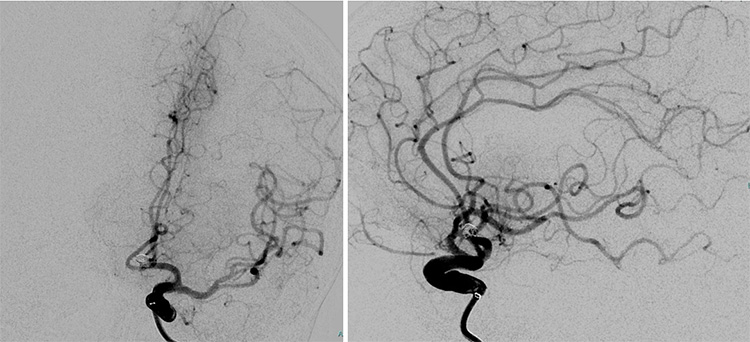Tale of dual Malady in a Ruptured Aneurysm