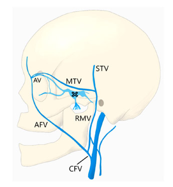 The common facial vein (CVF)