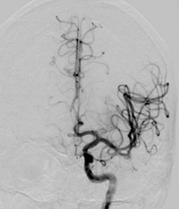 Thromboembolic LVO