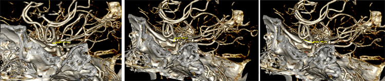 Transient Gerstmann syndrome following flow diversion of left ophthalmic artery giant aneurysm