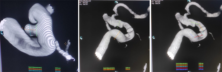 Transient Gerstmann syndrome following flow diversion of left ophthalmic artery giant aneurysm