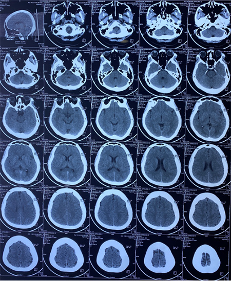 Transient Gerstmann syndrome following flow diversion of left ophthalmic artery giant aneurysm