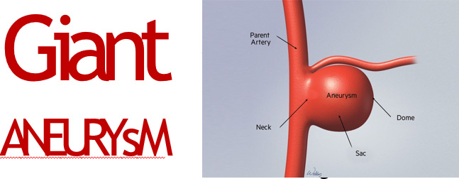 Transient Gerstmann syndrome following flow diversion of left ophthalmic artery giant aneurysm