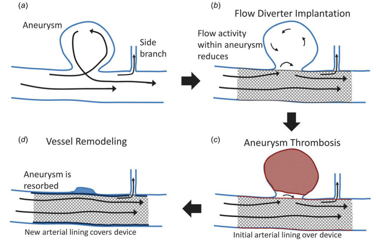 Transient Gerstmann syndrome following flow diversion of left ophthalmic artery giant aneurysm