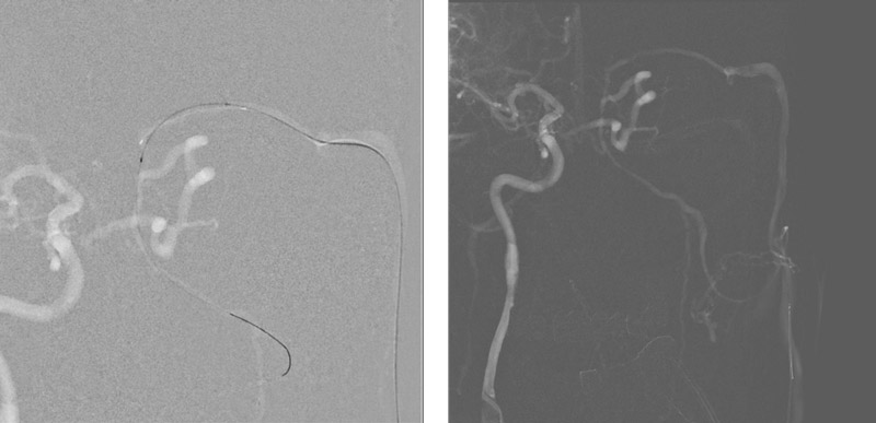Transverse facial vein