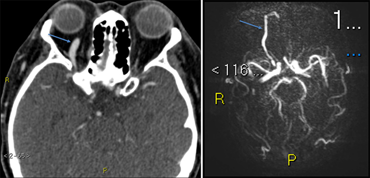 Tunnelling-for-Gold-(through-an-occluded-SOV-in-CCF)