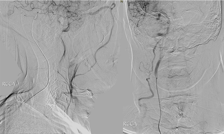 Tunnelling for Gold (through an occluded SOV in CCF)