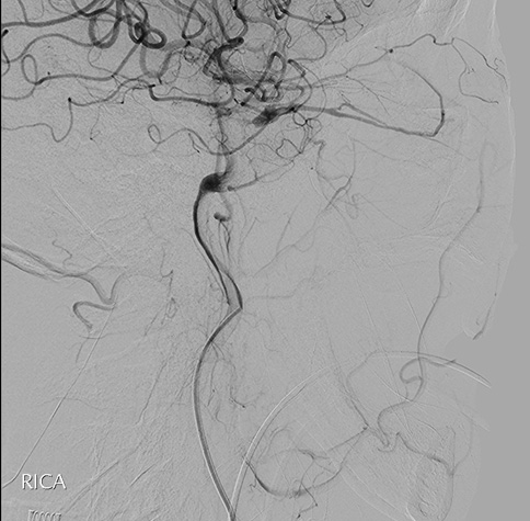 Tunnelling for Gold (through an occluded SOV in CCF)