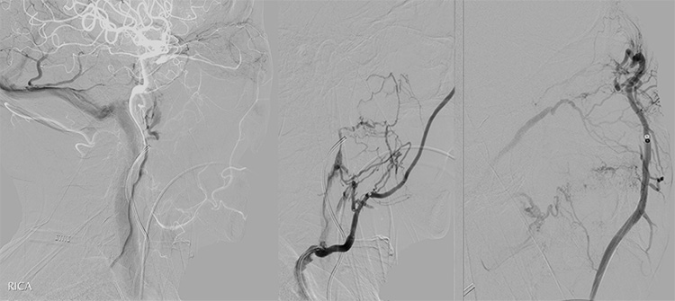 Tunnelling for Gold (through an occluded SOV in CCF)