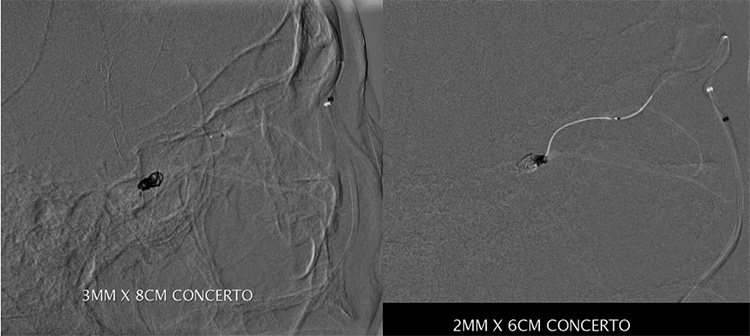 Tunnelling for Gold (through an occluded SOV in CCF)