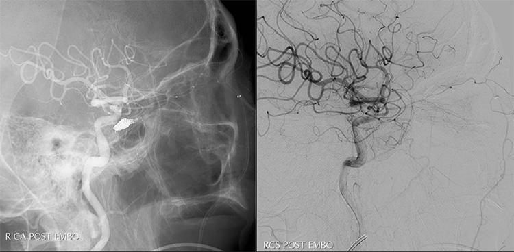 Tunnelling for Gold (through an occluded SOV in CCF)