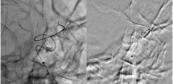 Twisted FD treatment